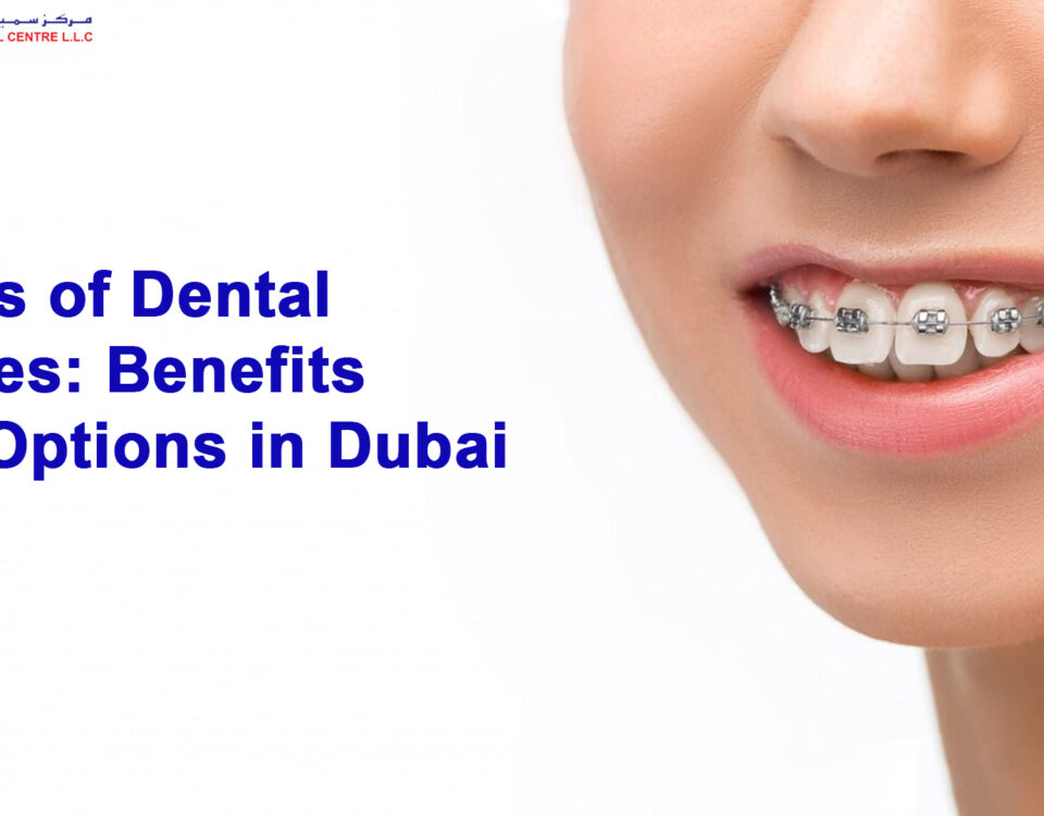 Types of Dental Braces: Benefits and Options in Dubai