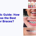 how to choose bes braces colors dental sharjah